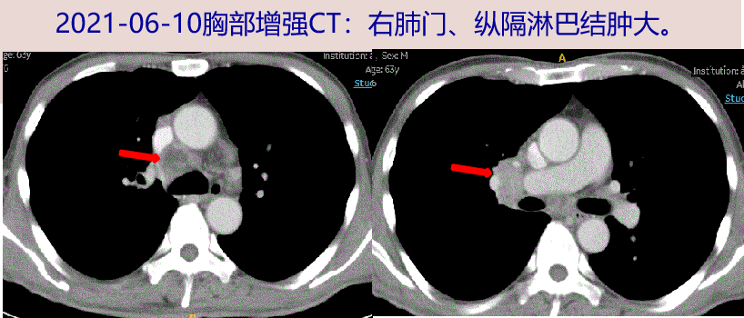 探案丨反复高热,会是肿瘤复发吗?