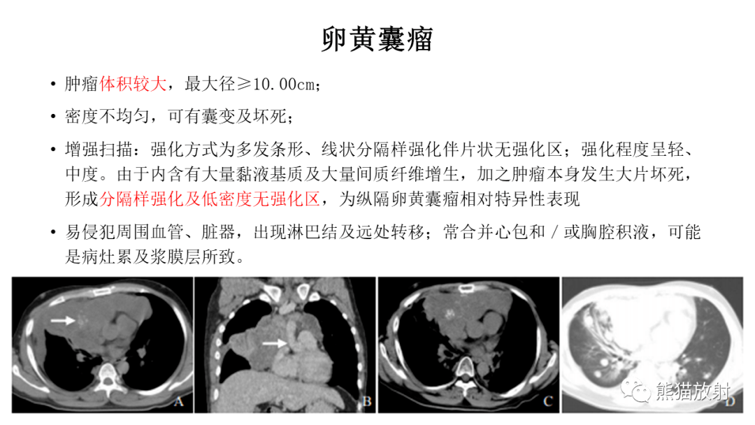 【书摘】"纵隔囊性肿块"的鉴别诊断  【双语病例】(前纵隔)生殖细胞