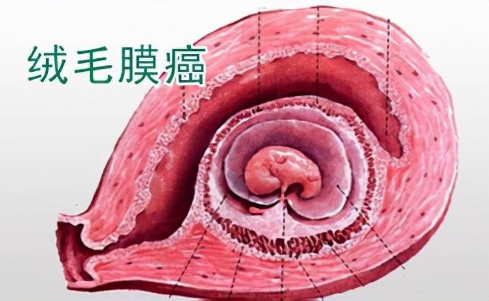病人咳血以为是肺癌,结果却是妇科少见的恶性肿瘤