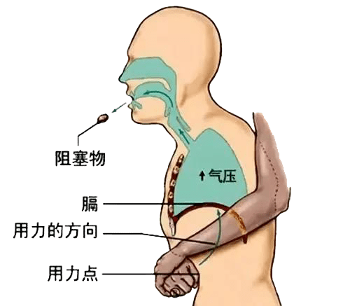 2岁孩童异物卡喉新泰市中医医院护士用海姆立克法紧急抢救