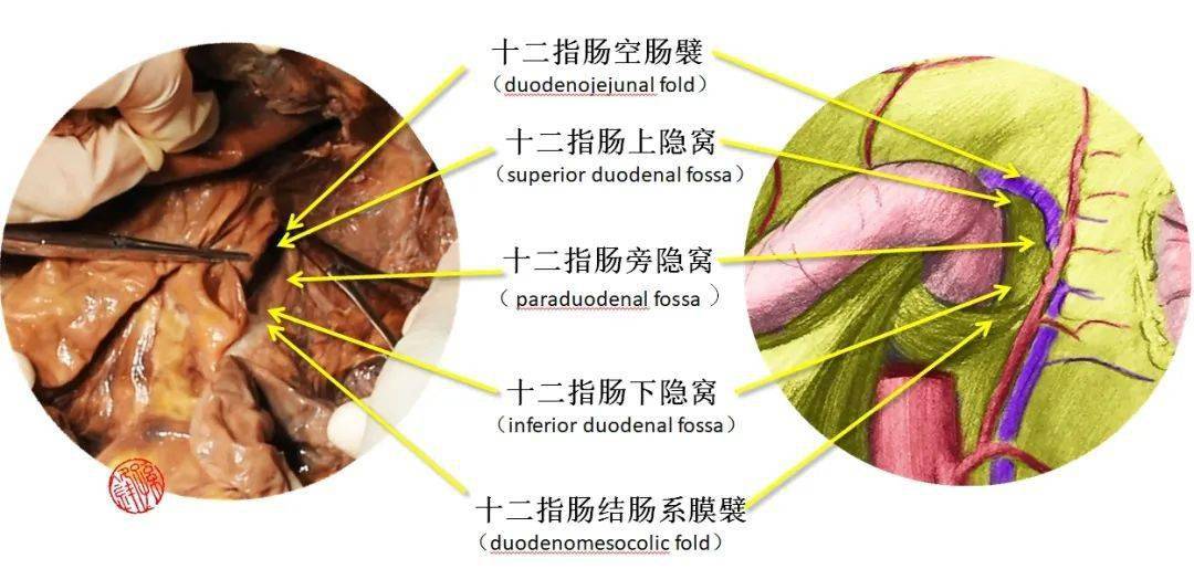 医学图说|十二指肠旁隐窝的应用解剖学