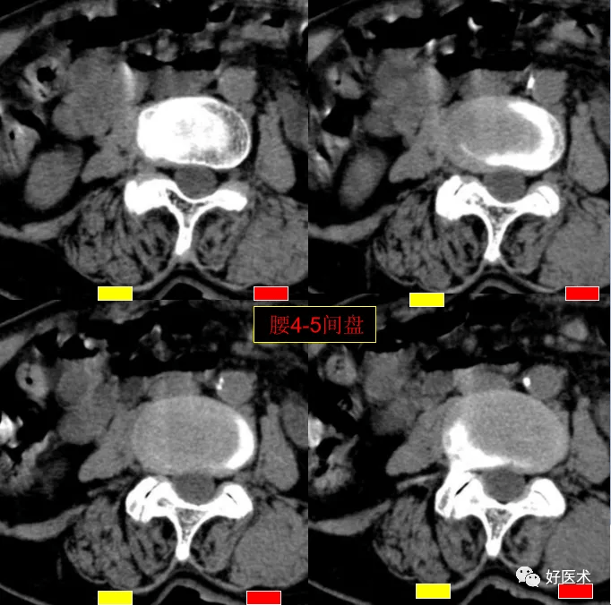 重要发现:这份"无漏洞"的腰部ct为影像科医生敲响警钟