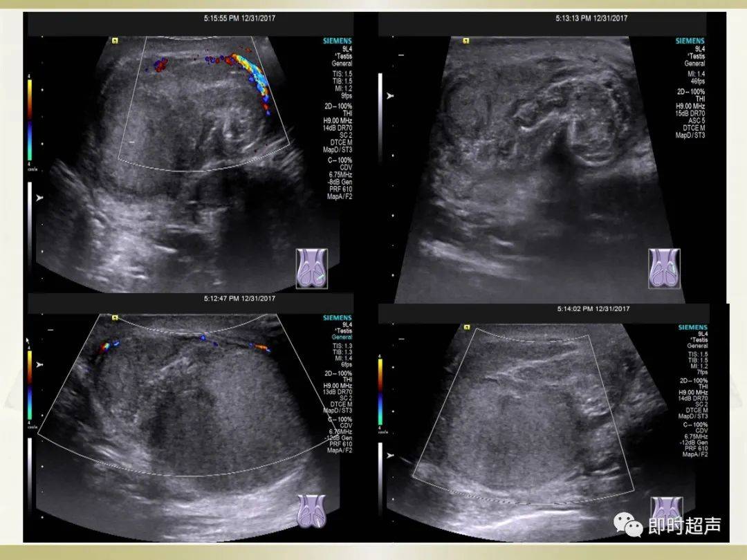 阴囊超声应用解剖及相关急症的超声诊断._睾丸