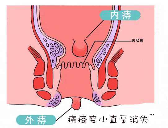 痔疮自愈3个小偏方,不打针,不吃药,坚持1个月以上的人