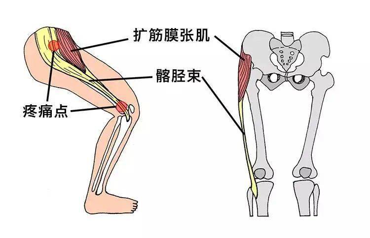 跑步膝的医学名称叫髂胫束摩擦综合症,它是身体相关运动系统不协调