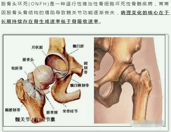 这就是股骨头的解剖图(图片来源于网络)