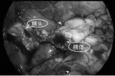我院成功开展腹腔镜保留十二指肠胰头切除术治疗儿童高胰岛素血症