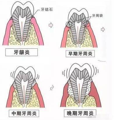 当有牙周炎且治疗不得当时,结缔组织附着降低,探诊深度超过3mm,探针能