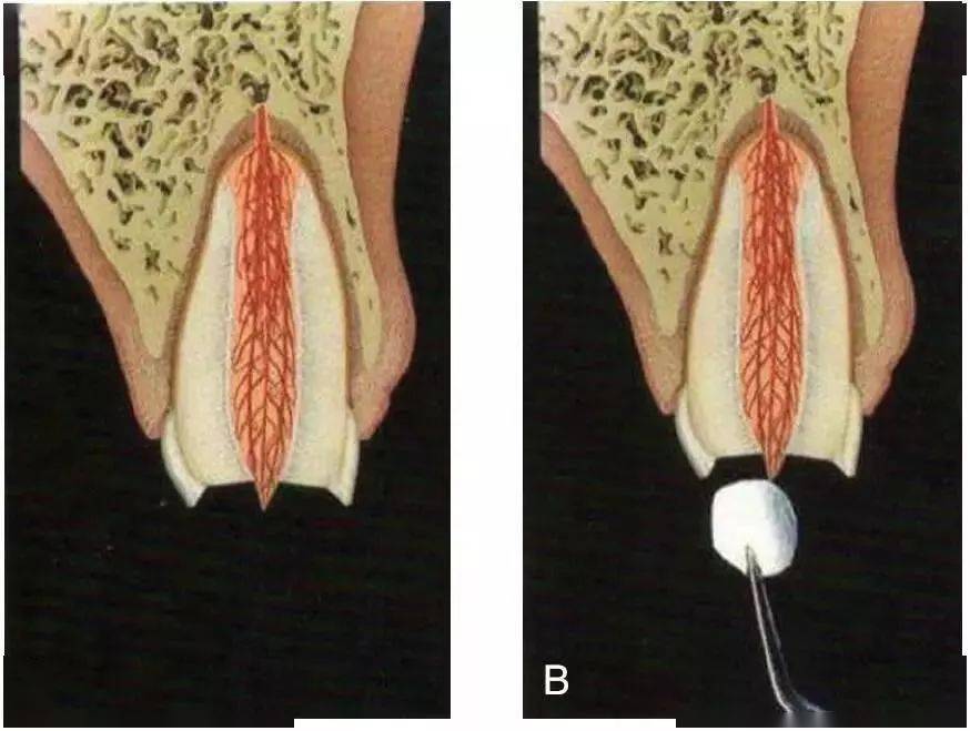 活髓切断术步骤图解牙齿的牙髓可以分为牙冠部的冠髓和牙根部的根髓两