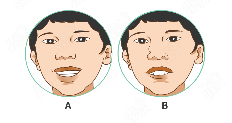 左边正常,右边腺样体面容