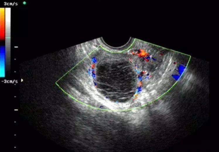 注意:经腹超声常不能清晰地显示卵巢内的细微结构,尤其是在肥胖