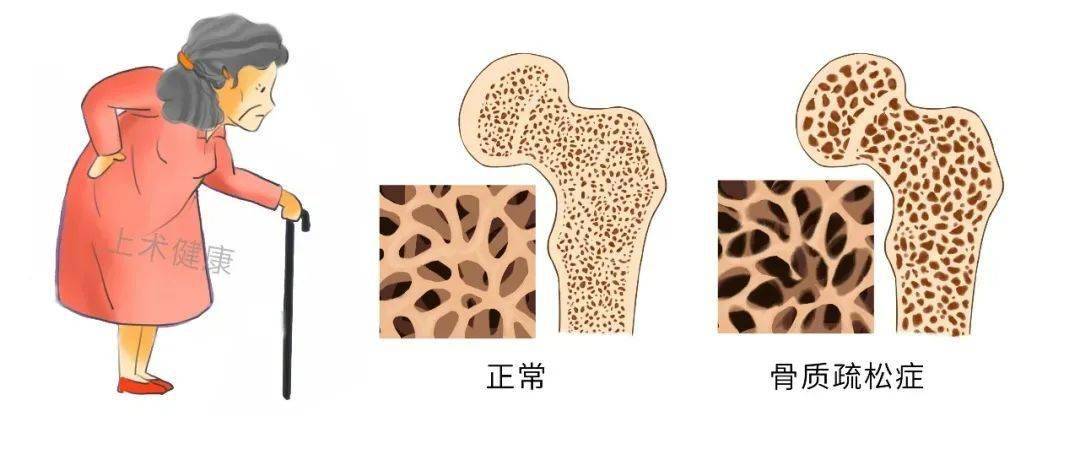 安全用药绝经后骨质疏松高发究竟该如何补钙