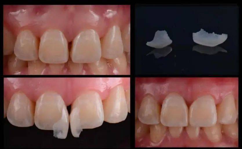 缝前牙轻微排列异常等氟斑牙过小牙扭转牙前牙黑三角前牙牙缝前牙邻