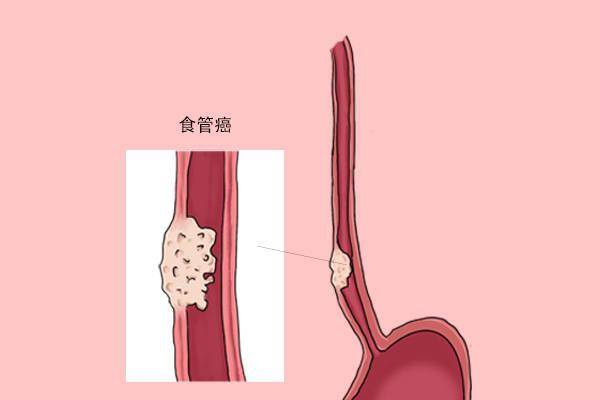 全球一半食管癌在中国牢记1个字或能降低风险不要算错账