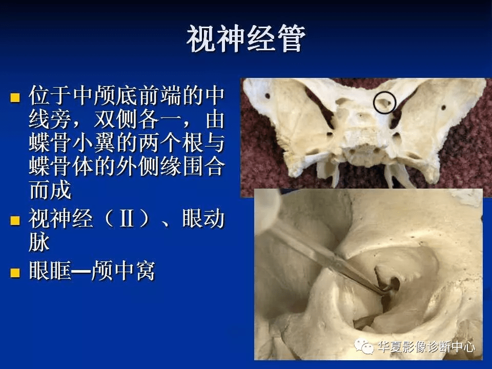 实用,详细的颅底各孔道影像解剖_结构_动脉_神经