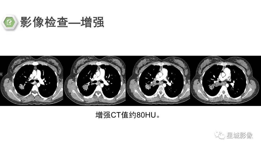 纵隔支气管囊肿合并炎性假瘤_影像_常读_黎彩虹