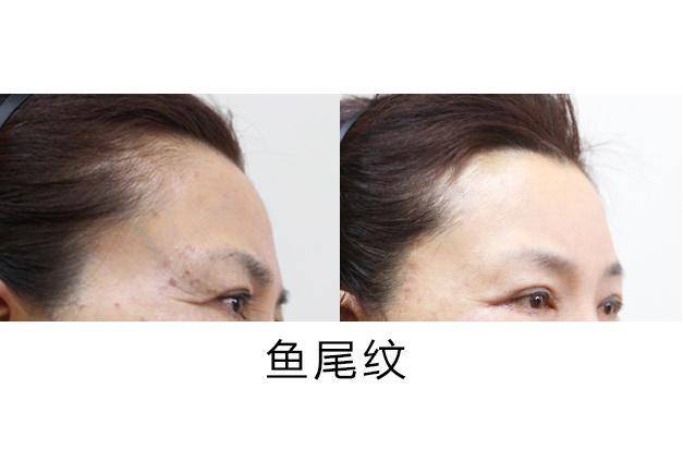 此种方法除抬头纹,川字纹,眉间纹,眼角鱼尾纹,鼻背纹,效果比较好,见效