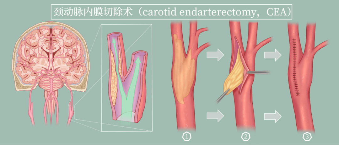 主要的治疗手段包括药物保守治疗,搭桥手术,颈动脉内膜切除术(carotid