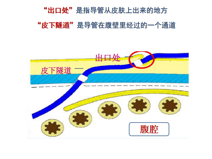 腹膜透析导管生命线,护理是关键_患者_出口_温州市中心