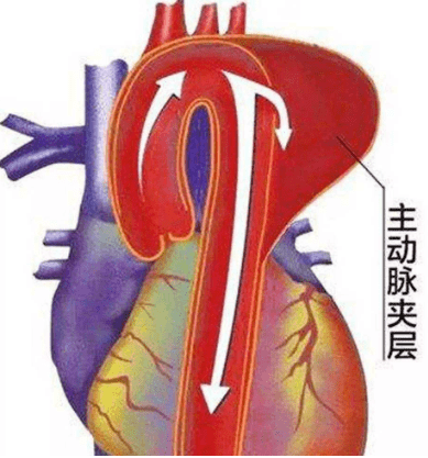 主动脉夹层被称为"人体炸弹",是目前人类最危重的疾病之一,是指主