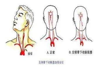 宁波华美血管外科团队探索弓上动脉病变腔内微创治疗新模式巧克力球囊