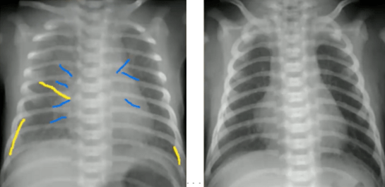 读完此文,终于会看儿童胸片了_新生儿_阴影_气管