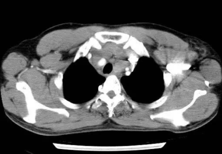 纵隔淋巴瘤_诊断_淋巴结_影像