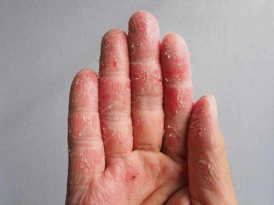 湿疹/皮炎这里举几个会导致手部脱皮(屑)的疾病,方便大家初步评估,但