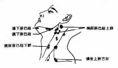 艾灸疏通淋巴从根本排毒