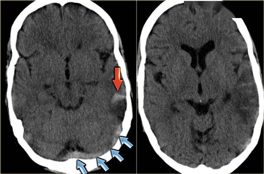 下图为颞叶出血性脑梗死(红色箭头.