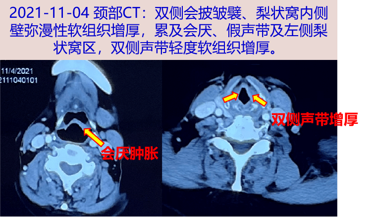 甲状腺功能,肿瘤标志物;自身抗体:抗核抗体 1:100,其余;免疫