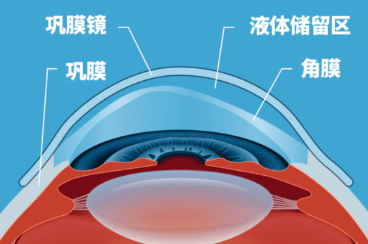 着陆于巩膜上方的结膜组织大直径硬性透气性接触镜,日间配戴/什么是