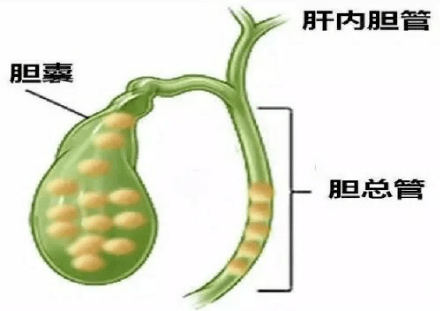 胆总管结石50%以上的急性胰腺炎是由胆囊结石诱发的.