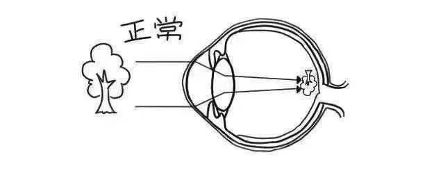 几个动作,怀疑娃眼睛有问题,一查300度!