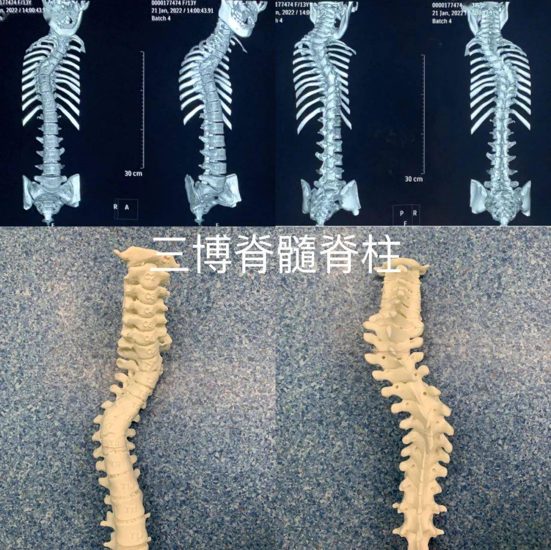 【典型病例】脊髓髓内畸胎瘤合并先天性脊柱发育畸形