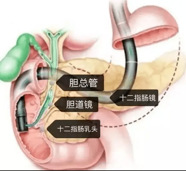 积液从ct片可以看到患者胆总管内大大小小有十余个结石,多数直径在1