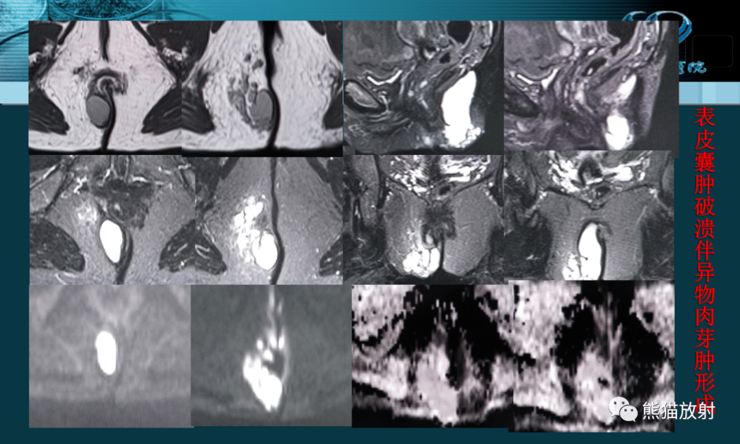 讲座丨盆底解剖与肛周病变的mri表现(蔡世峰教授)_肛管_直肠_肛门