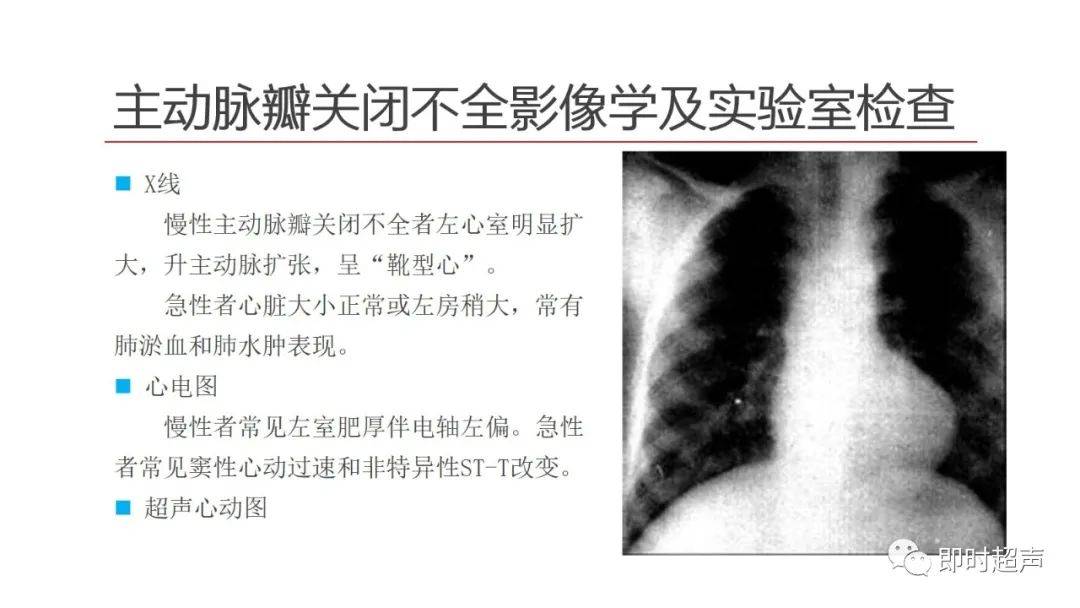 主动脉瓣狭窄及关闭不全
