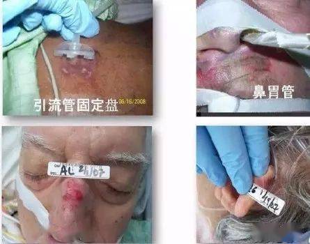 气管切开套管等,长时间压迫局部皮肤,造成医疗器械相关性压疮(mdrpu)