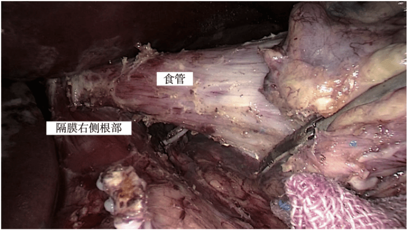 图14 食管周围解剖到达脾下极,左手抓钳向腹侧及右侧牵起胃网膜左系膜