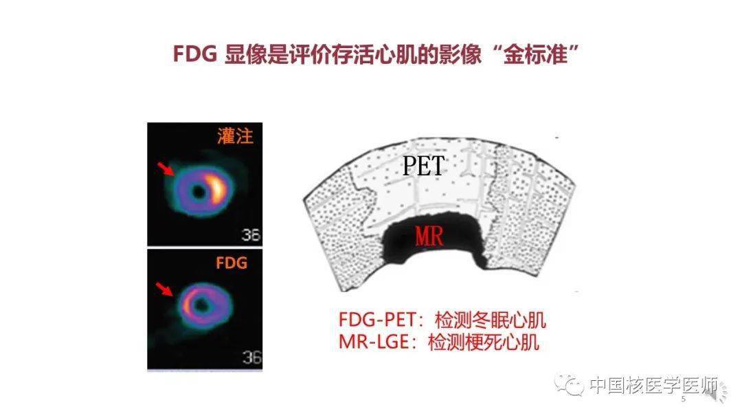 【核汇园】67期:杨敏福教授 fdg心血管显像的拓