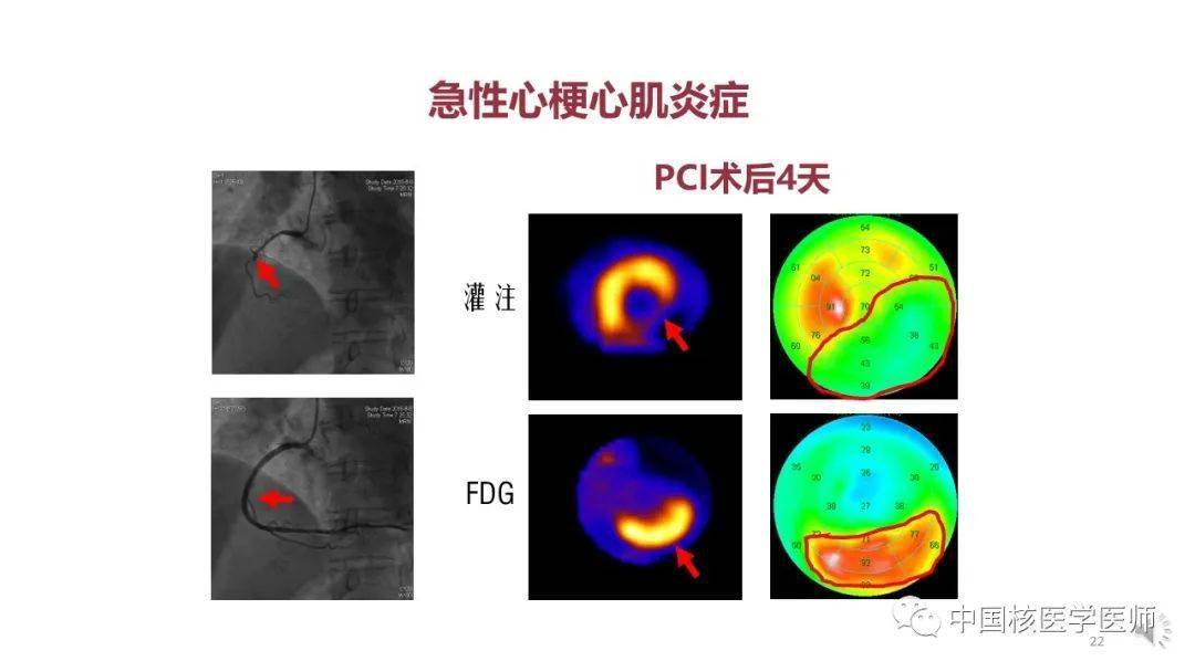 【核汇园】67期:杨敏福教授 fdg心血管显像的拓