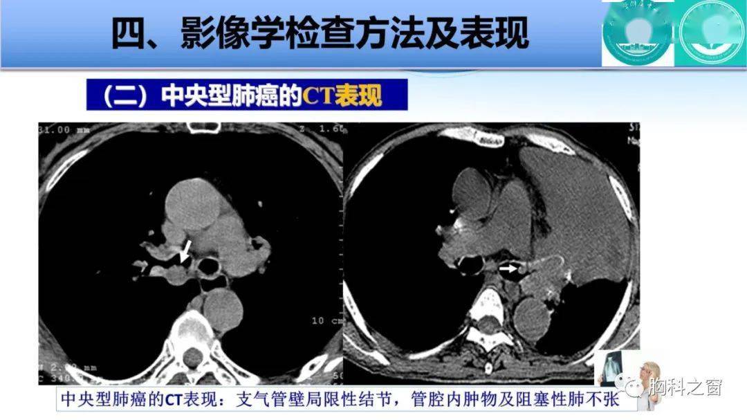 中央型肺癌的影像学表现及相关疾病鉴别诊断