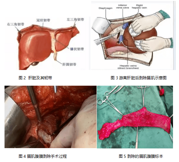 淄博市第一医院妇科成功为患者实施卵巢癌超根治手术_腹膜_群众_化疗