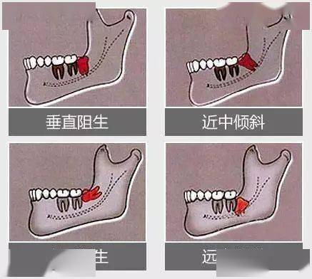 长痛不如短痛请一定要及时抛弃你的阻生智齿