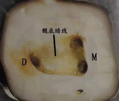 髓腔和根管口的解剖规律"根管口"寻找_远中_定位_牙齿