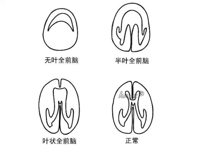 2,半叶全前脑:大脑半球及侧脑室仅在后侧分开,单一侧脑室,丘脑融合或