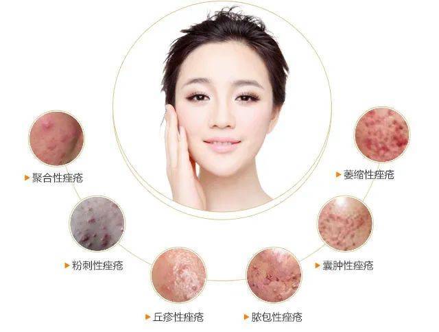 痤疮分级治疗,祛痘效果更明显_方法_粉刺_皮损