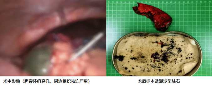 多学科合作,广安门医院成功实施百岁高危患者微创胆囊