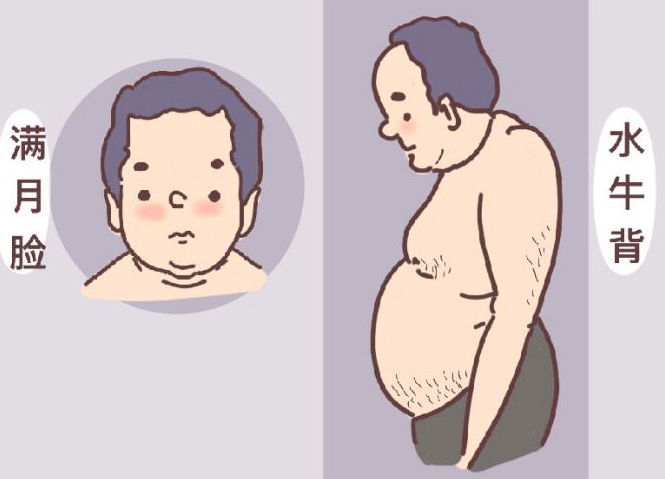 典型表现就是"变丑,比如大饼脸(满月脸,虎背熊腰(水牛背,向心性肥胖